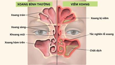 Biểu hiện viêm xoang